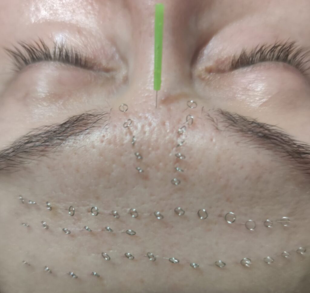 Akupunktura kosmetyczna